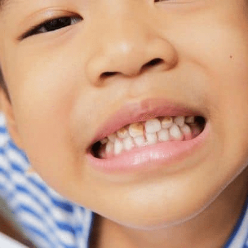 Symptoms of Tooth Decay in Kids