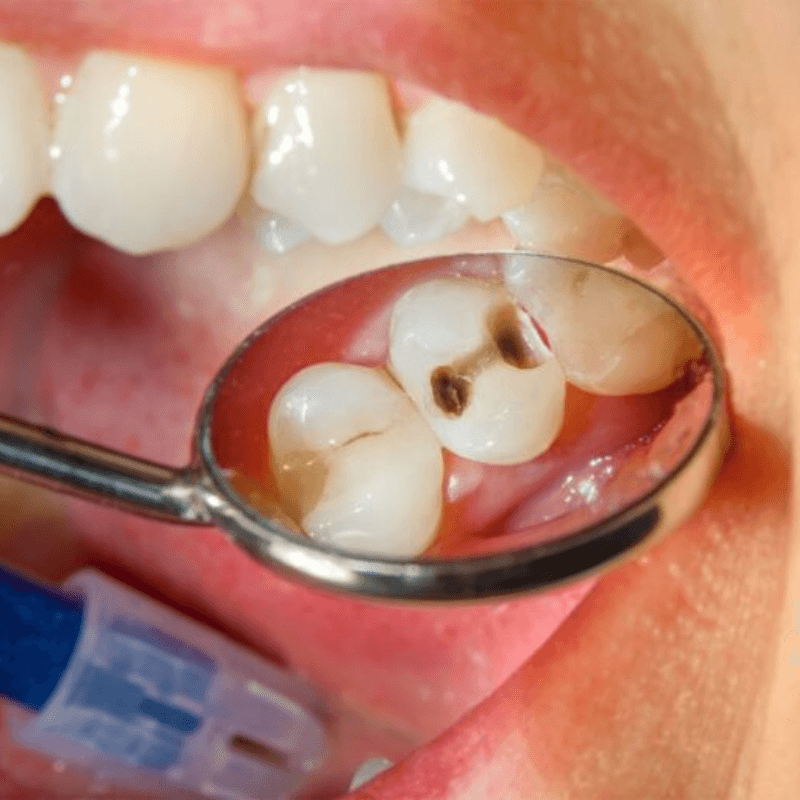 Tooth Decay Treatment in Kids