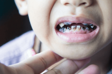 Tooth Decay in Kids