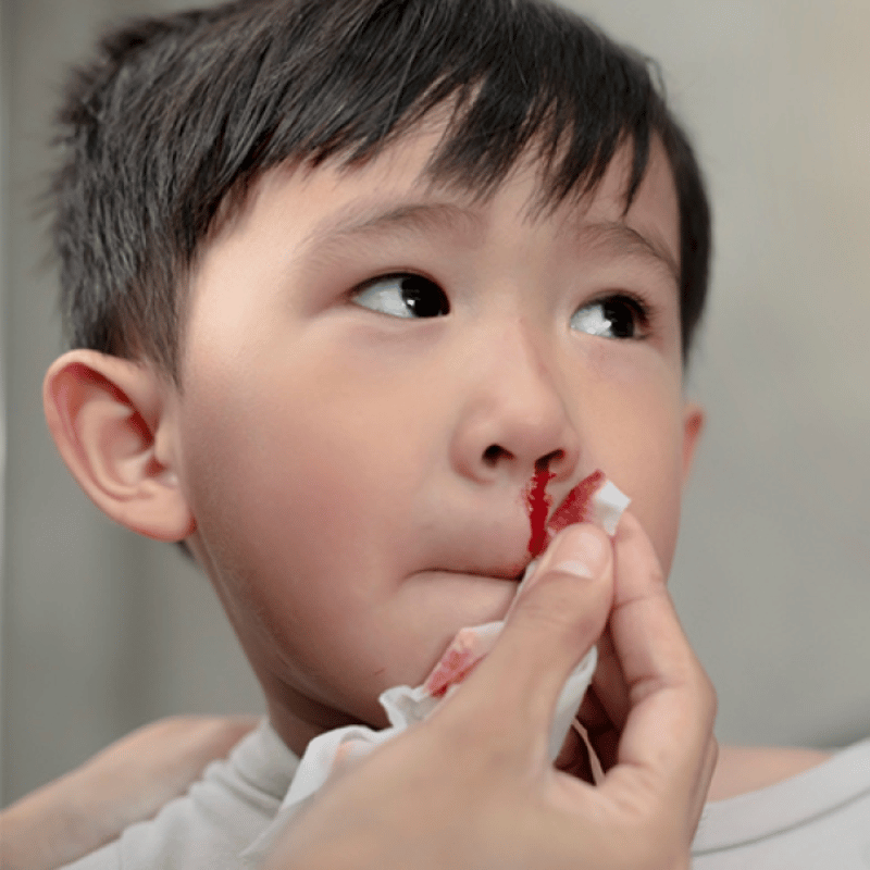 Causes of Nose Bleed in Children